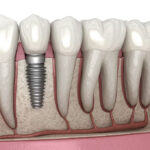 Sustainable Solutions: Eco-Friendly Advances in Dental Implants