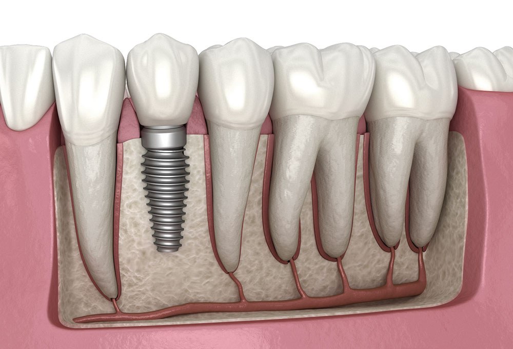 Sustainable Solutions: Eco-Friendly Advances in Dental Implants